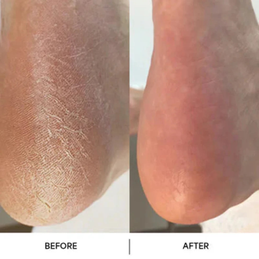 Before and after comparison of a foot with visible skin texture changes.