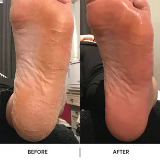 Before and after comparison of a foot with visible calluses.